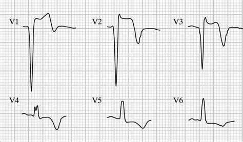 ventricular aneurysm ecg